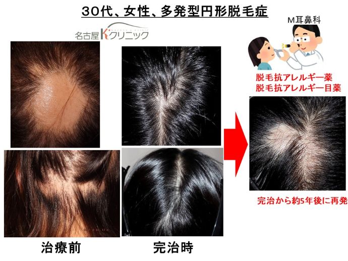 円形脱毛症　病院